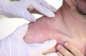 El Instituto Dermatológico detecta 266 casos de cáncer de piel en dos meses