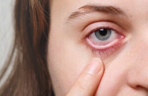 Aumentan los casos de conjuntivitis viral en las consultas oftalmológicas