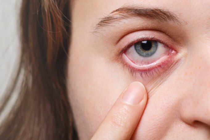 Aumentan los casos de conjuntivitis viral en las consultas oftalmológicas